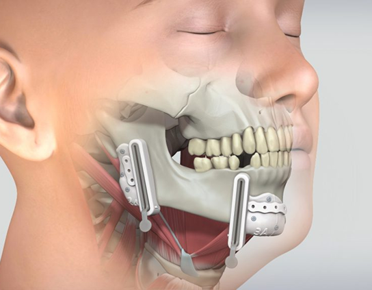 What Is Mandibular Reconstruction?