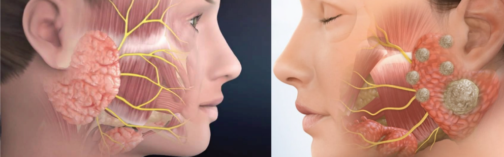 What Is a Parotid Tumour?